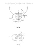 Non-Thermal Ablation System for Treating Tissue diagram and image