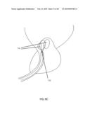 Non-Thermal Ablation System for Treating Tissue diagram and image