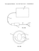 Non-Thermal Ablation System for Treating Tissue diagram and image