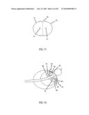 Non-Thermal Ablation System for Treating Tissue diagram and image