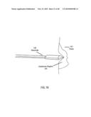 Non-Thermal Ablation System for Treating Tissue diagram and image