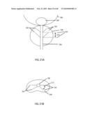 Non-Thermal Ablation System for Treating Tissue diagram and image