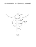 Non-Thermal Ablation System for Treating Tissue diagram and image