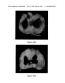 Non-Thermal Ablation System for Treating Tissue diagram and image