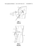 TIBIAL GUIDE FOR ACL REPAIR HAVING LEFT/RIGHT DOCKING CONFIGURATION diagram and image