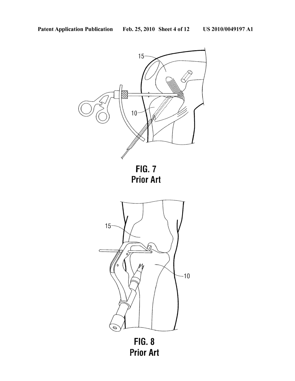 TIBIAL GUIDE FOR ACL REPAIR HAVING LEFT/RIGHT DOCKING CONFIGURATION - diagram, schematic, and image 05