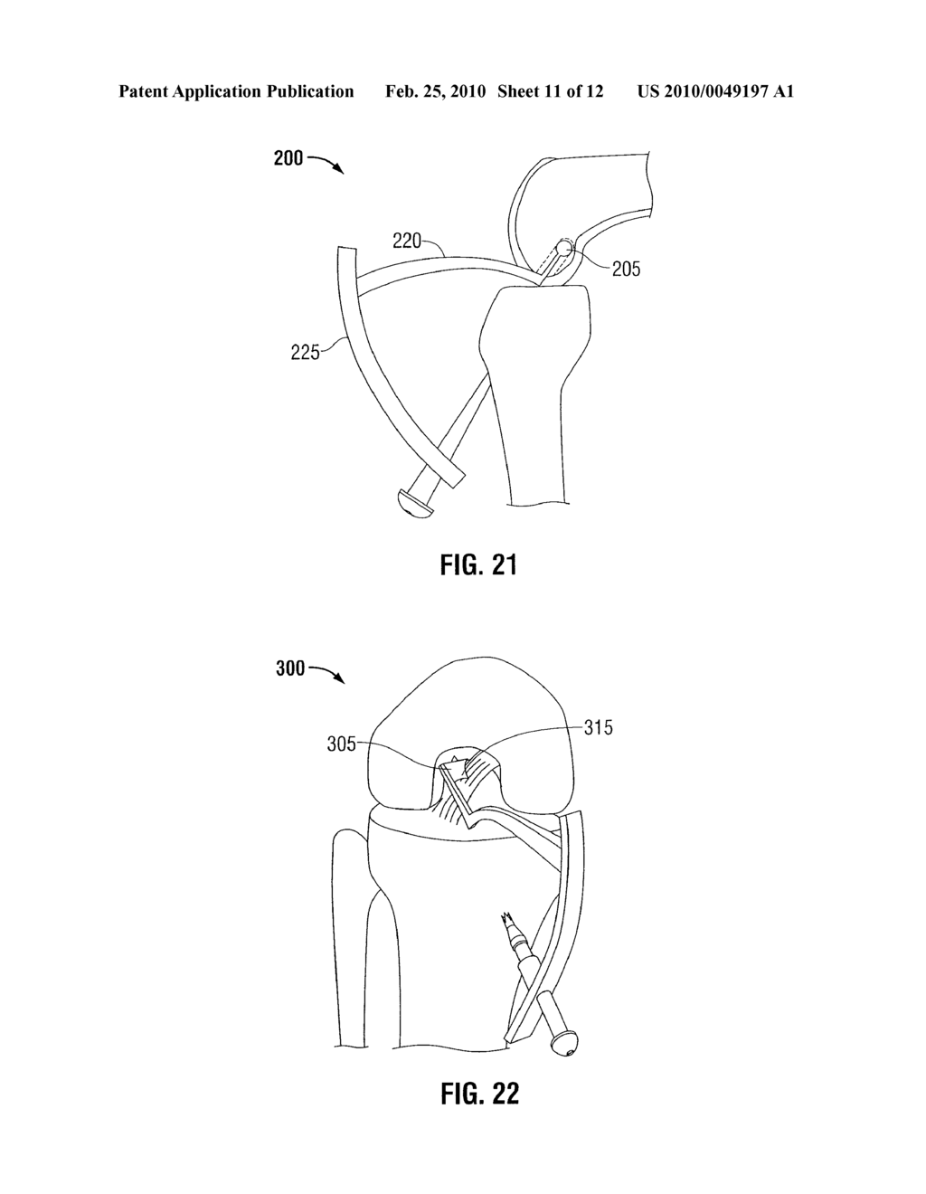 TIBIAL GUIDE FOR ACL REPAIR HAVING LEFT/RIGHT DOCKING CONFIGURATION - diagram, schematic, and image 12