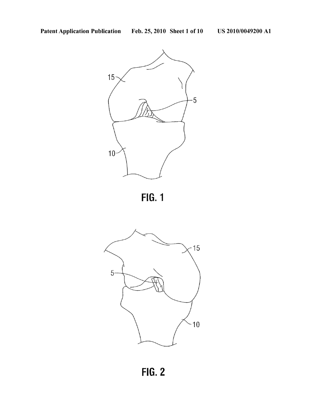 FEMORAL GUIDE FOR ACL REPAIR HAVING ADJUSTABLE OFFSET - diagram, schematic, and image 02