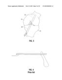 FEMORAL GUIDE FOR ACL REPAIR HAVING REDUCED PROFILE FOR LEFT/RIGHT KNEE CONFIGURATIONS diagram and image