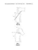 FEMORAL GUIDE FOR ACL REPAIR HAVING REDUCED PROFILE FOR LEFT/RIGHT KNEE CONFIGURATIONS diagram and image