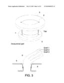 PROSTHESIS FOR ANASTOMOSIS diagram and image