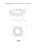 PROSTHESIS FOR ANASTOMOSIS diagram and image