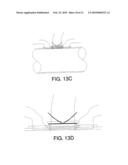 PROSTHESIS FOR ANASTOMOSIS diagram and image