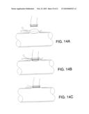 PROSTHESIS FOR ANASTOMOSIS diagram and image