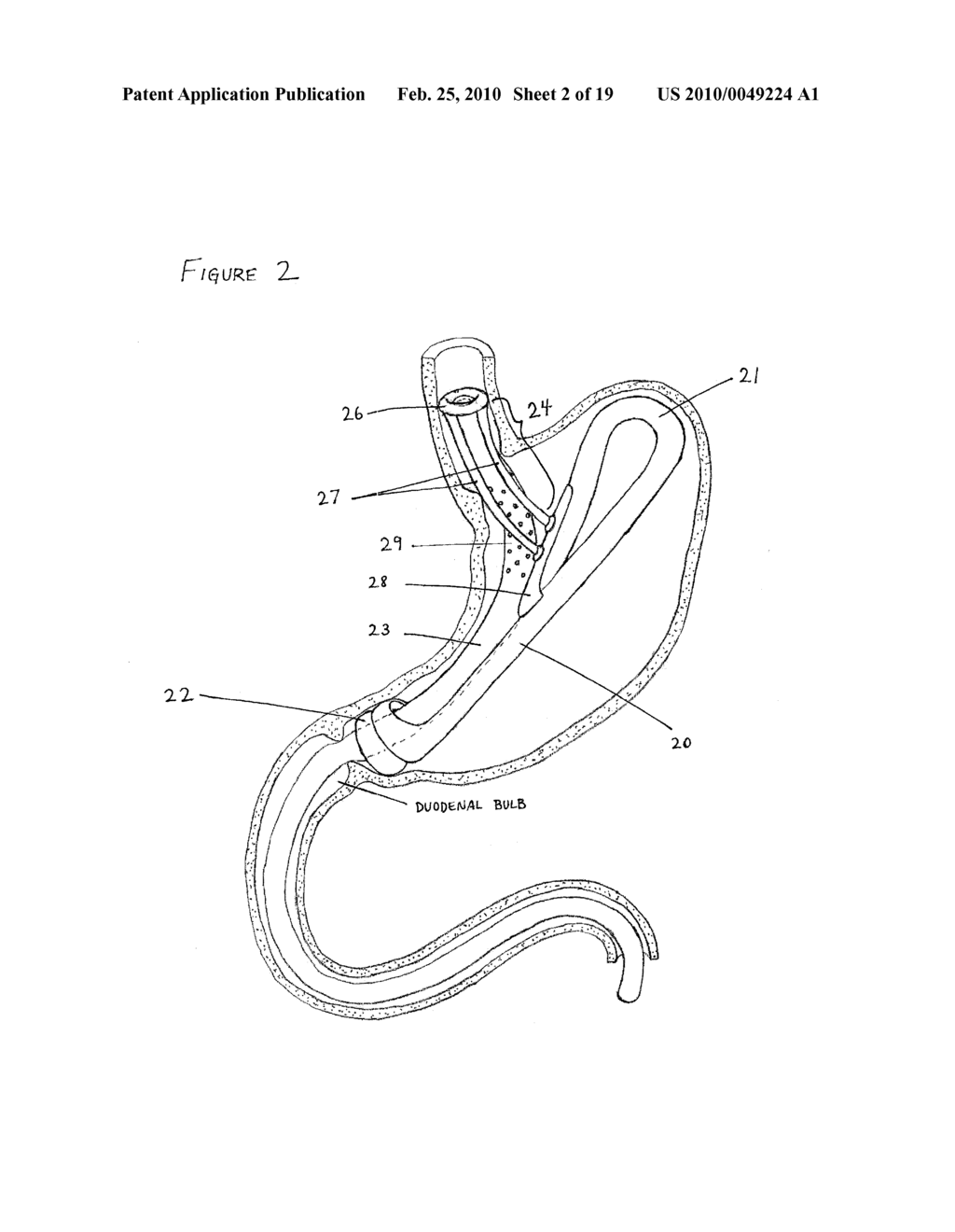 Intragastric Implant Devices - diagram, schematic, and image 03