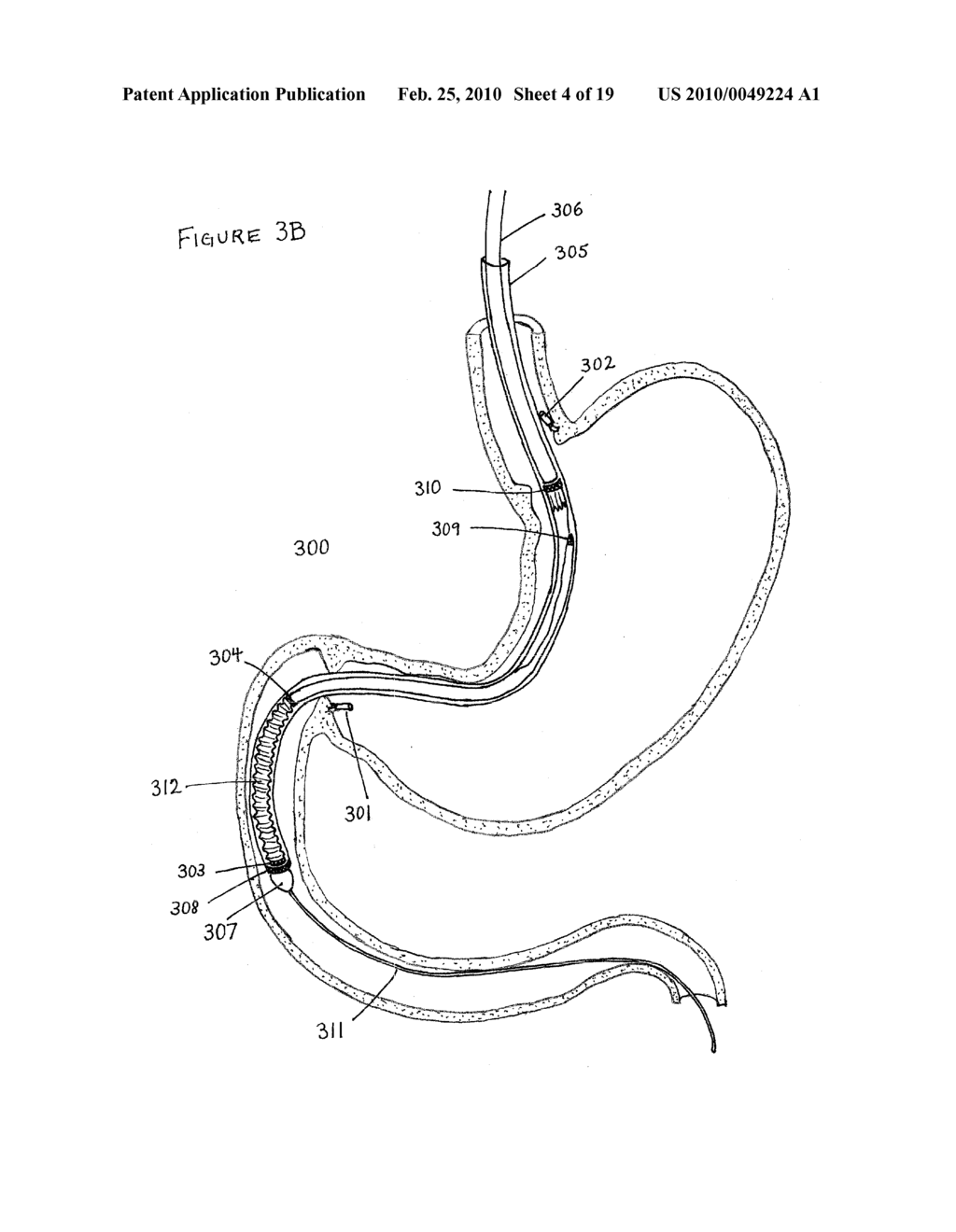 Intragastric Implant Devices - diagram, schematic, and image 05