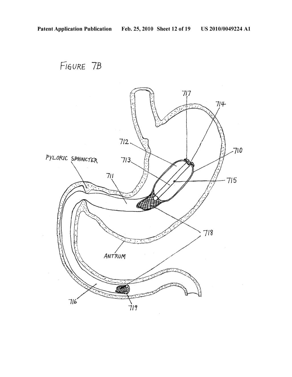 Intragastric Implant Devices - diagram, schematic, and image 13