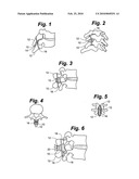 METHOD AND DEVICE FOR INTERSPINOUS PROCESS FUSION diagram and image