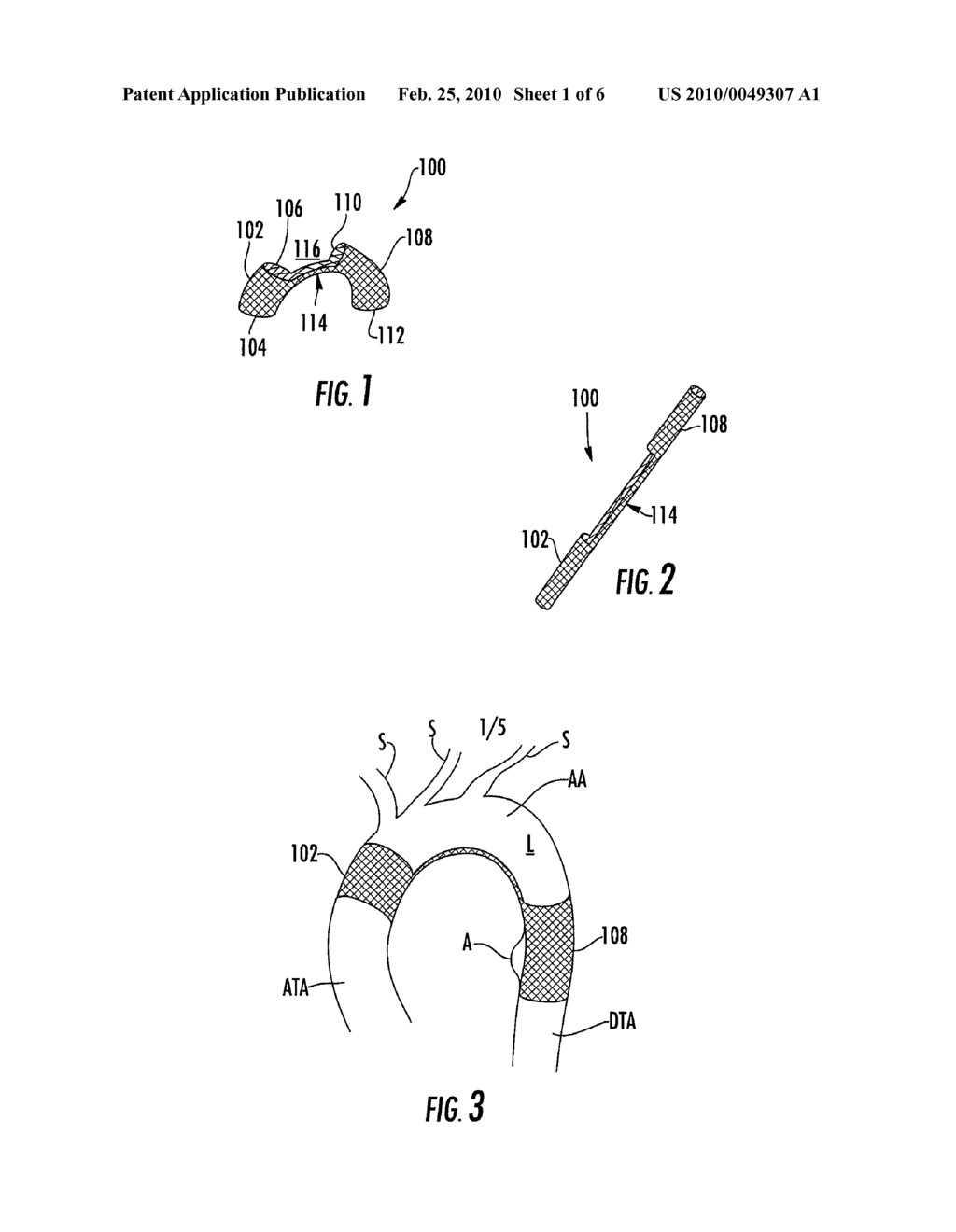 STENT GRAFT HAVING EXTENDED LANDING AREA AND METHOD FOR USING THE SAME - diagram, schematic, and image 02