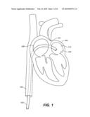 METHODS, DEVICES, AND KITS FOR TREATING MITRAL VALVE PROLAPSE diagram and image