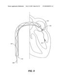 METHODS, DEVICES, AND KITS FOR TREATING MITRAL VALVE PROLAPSE diagram and image