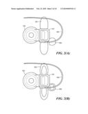 Implantable Housing With Stabilizer diagram and image