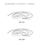 Implantable Housing With Stabilizer diagram and image