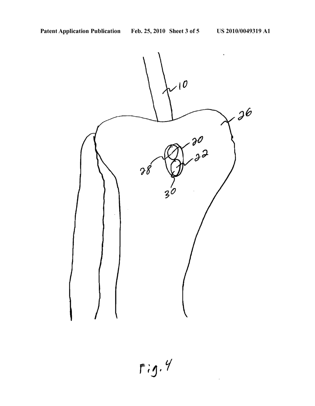 SINGLE-TUNNEL DOUBLE BUNDLE ANTERIOR CRUCIATE LIGAMENT RECONSTRUCTION - diagram, schematic, and image 04