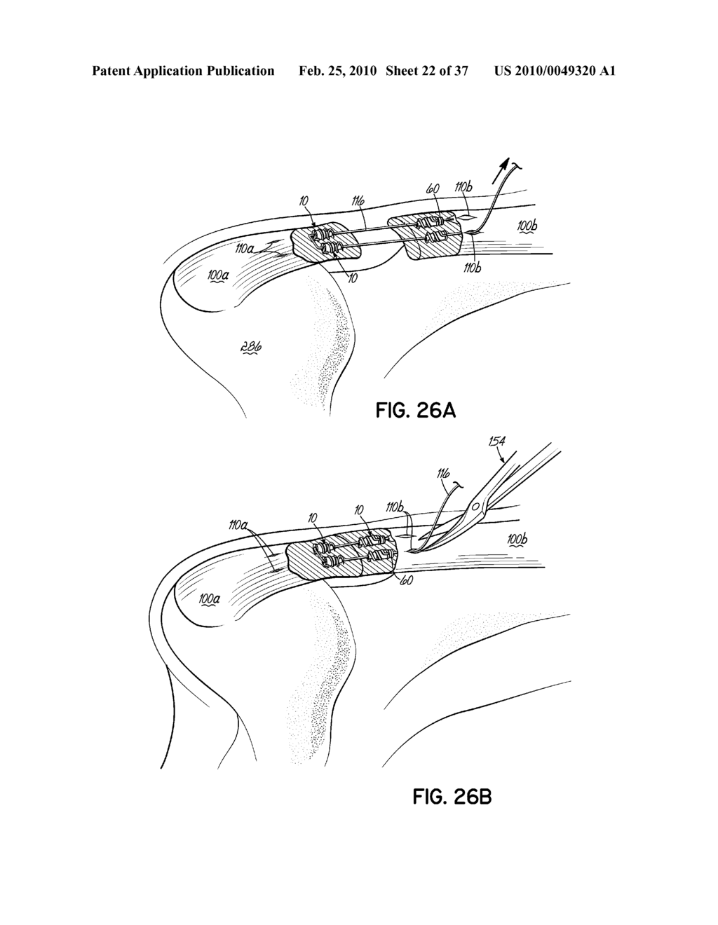 APPARATUS AND METHODS FOR TENDON OR LIGAMENT REPAIR - diagram, schematic, and image 23