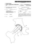 Coxo-femoral surface prosthesis for veterinary use diagram and image