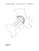 Coxo-femoral surface prosthesis for veterinary use diagram and image