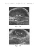 BRACHYTHERAPY SEED WITH FAST DISSOLVING MATRIX FOR OPTIMAL DELIVERY OF RADIONUCLIDES TO CANCER TISSUE diagram and image