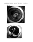 INJECTOR FOR EYE diagram and image