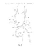 BRANCH STENT GRAFT FOR AORTIC ANEURYSM REPAIR diagram and image