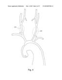 BRANCH STENT GRAFT FOR AORTIC ANEURYSM REPAIR diagram and image