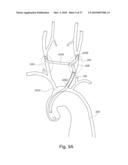 BRANCH STENT GRAFT FOR AORTIC ANEURYSM REPAIR diagram and image