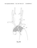 BRANCH STENT GRAFT FOR AORTIC ANEURYSM REPAIR diagram and image