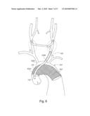 BRANCH STENT GRAFT FOR AORTIC ANEURYSM REPAIR diagram and image