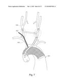 BRANCH STENT GRAFT FOR AORTIC ANEURYSM REPAIR diagram and image