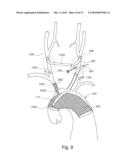 BRANCH STENT GRAFT FOR AORTIC ANEURYSM REPAIR diagram and image