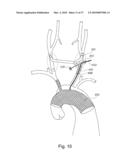 BRANCH STENT GRAFT FOR AORTIC ANEURYSM REPAIR diagram and image