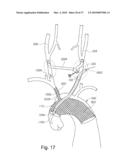 BRANCH STENT GRAFT FOR AORTIC ANEURYSM REPAIR diagram and image