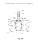 BRANCH STENT GRAFT FOR AORTIC ANEURYSM REPAIR diagram and image