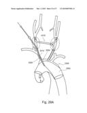 BRANCH STENT GRAFT FOR AORTIC ANEURYSM REPAIR diagram and image