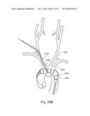 BRANCH STENT GRAFT FOR AORTIC ANEURYSM REPAIR diagram and image