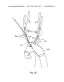 BRANCH STENT GRAFT FOR AORTIC ANEURYSM REPAIR diagram and image