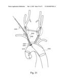 BRANCH STENT GRAFT FOR AORTIC ANEURYSM REPAIR diagram and image