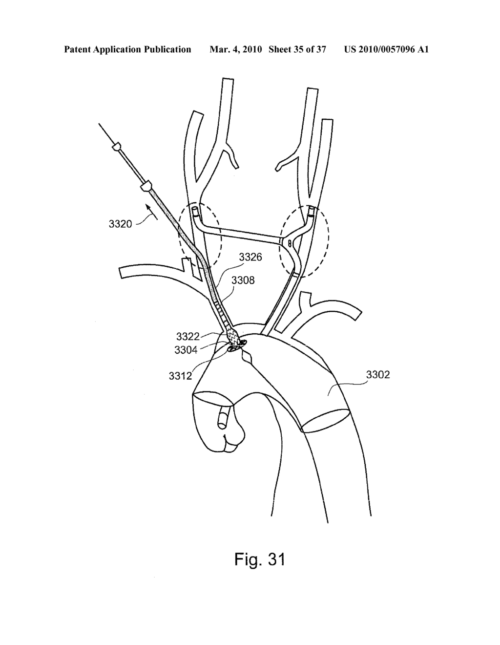 BRANCH STENT GRAFT FOR AORTIC ANEURYSM REPAIR - diagram, schematic, and image 36