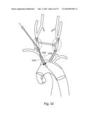 BRANCH STENT GRAFT FOR AORTIC ANEURYSM REPAIR diagram and image