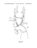 BRANCH STENT GRAFT FOR AORTIC ANEURYSM REPAIR diagram and image